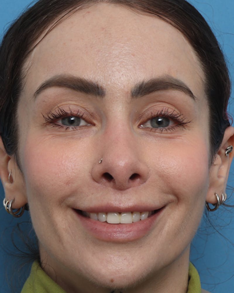 Lip Lift Before & After Gallery - Patient 180600 - Image 6