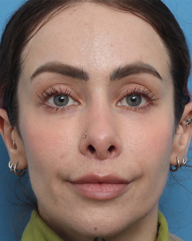 Lip Lift Before & After Gallery - Patient 180600 - Image 2