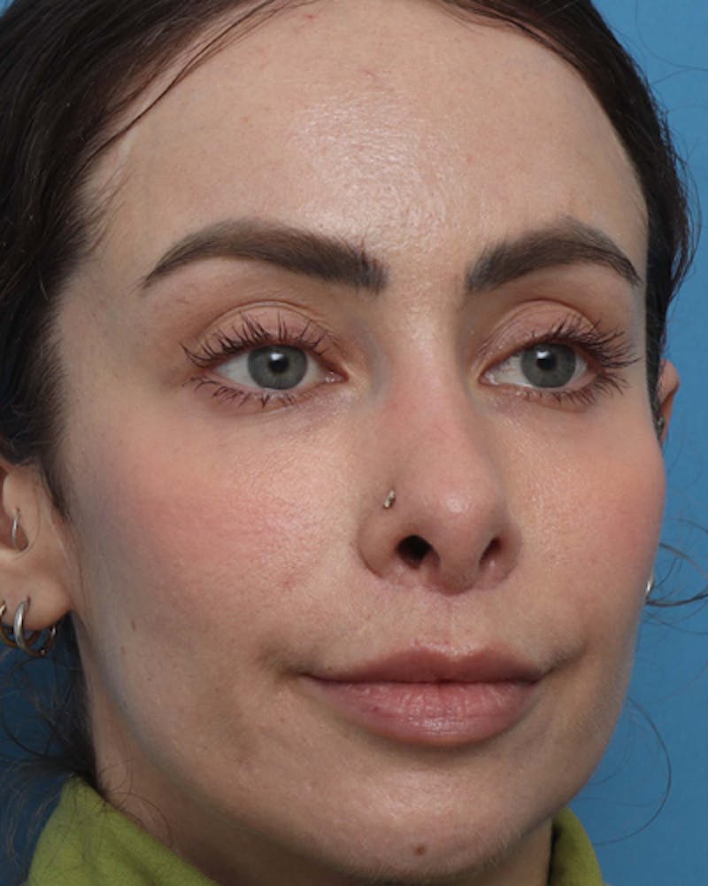 Lip Lift Before & After Gallery - Patient 180600 - Image 8