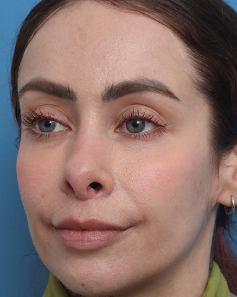 Lip Lift Before & After Gallery - Patient 180600 - Image 3