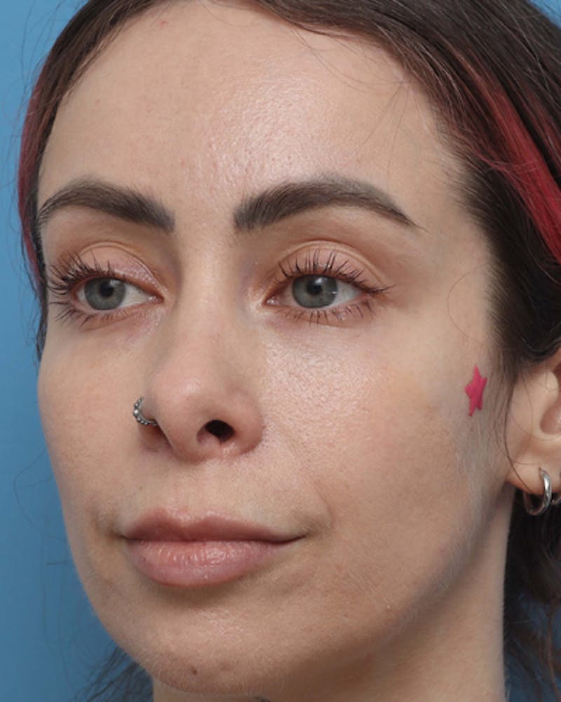 Lip Lift Before & After Gallery - Patient 180600 - Image 4