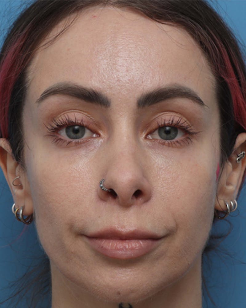 Lip Lift Before & After Gallery - Patient 180600 - Image 1