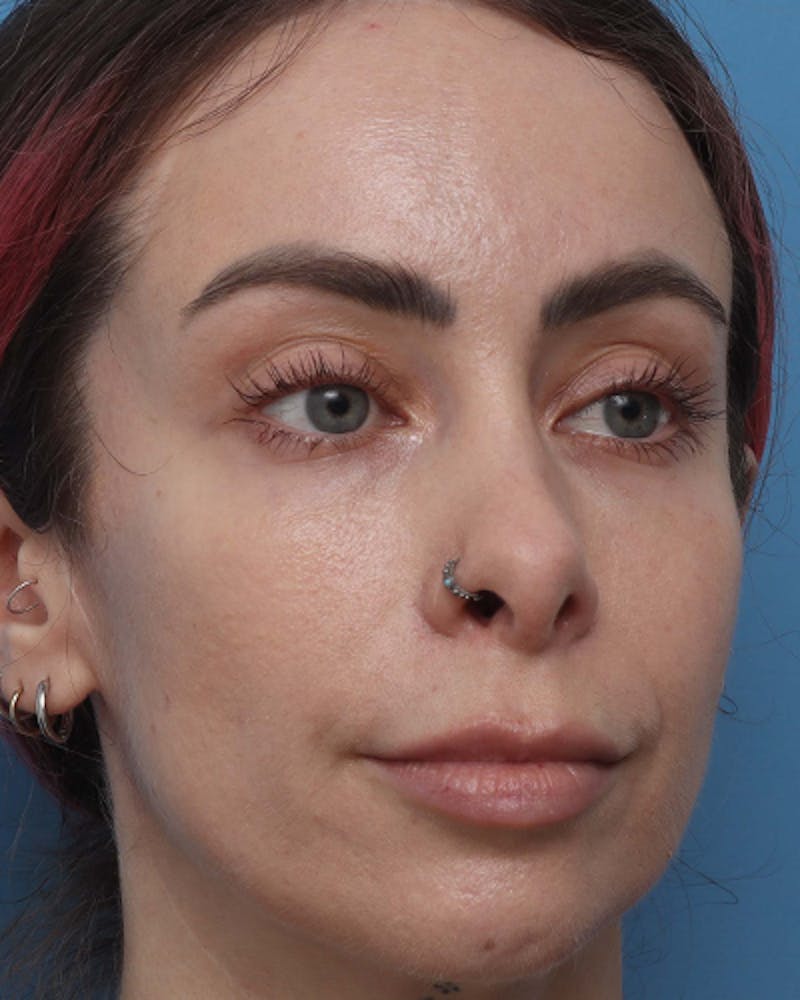 Lip Lift Before & After Gallery - Patient 180600 - Image 7