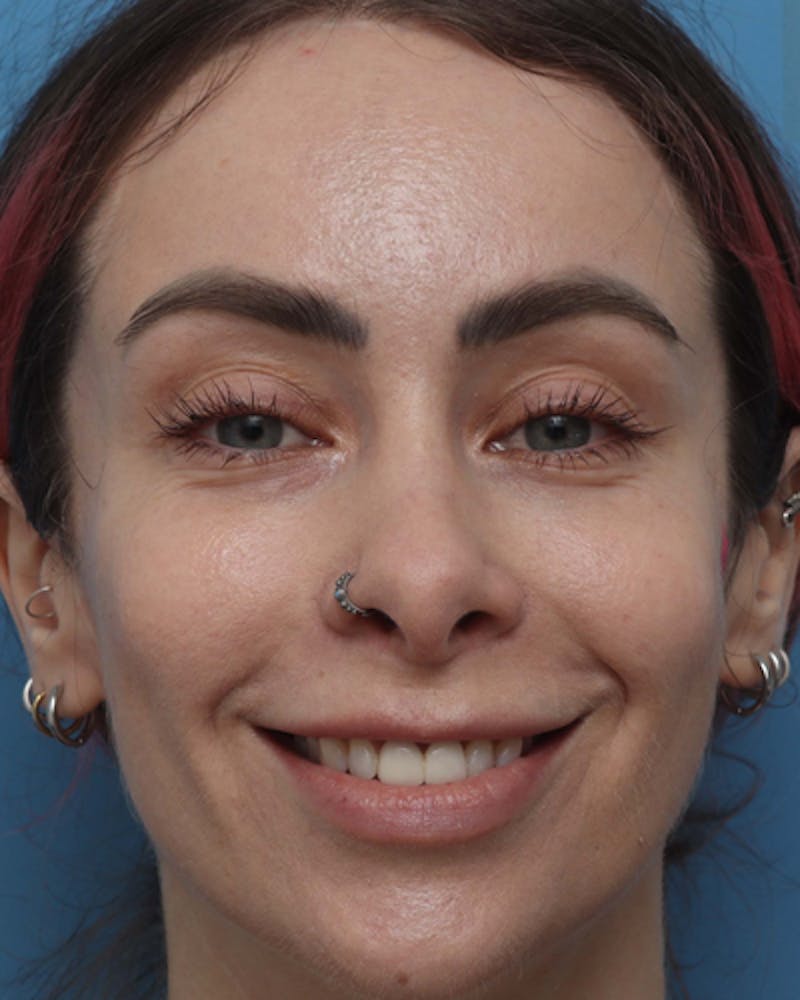 Lip Lift Before & After Gallery - Patient 180600 - Image 5