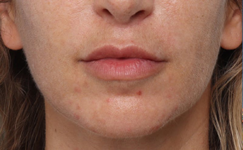 Lip Lift Before & After Gallery - Patient 167005 - Image 4