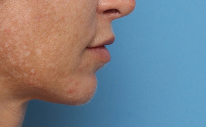 Lip Lift Before & After Gallery - Patient 167005 - Image 6