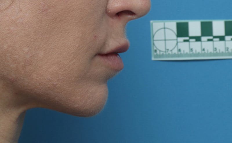 Lip Lift Before & After Gallery - Patient 167005 - Image 5