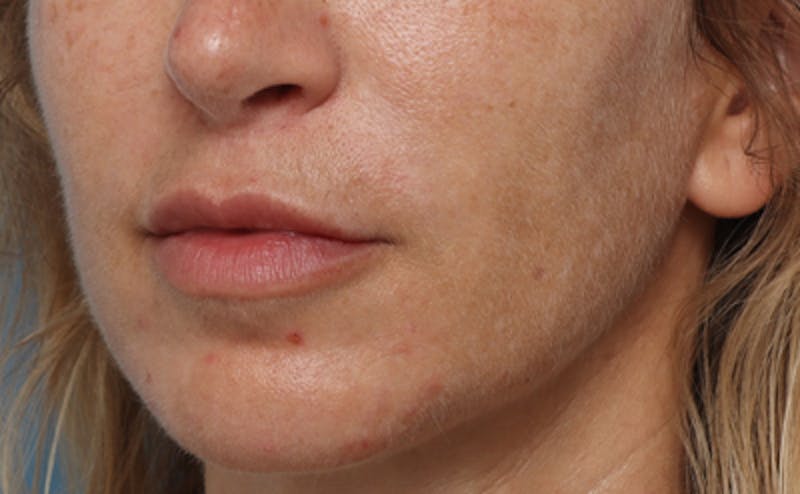 Lip Lift Before & After Gallery - Patient 167005 - Image 2
