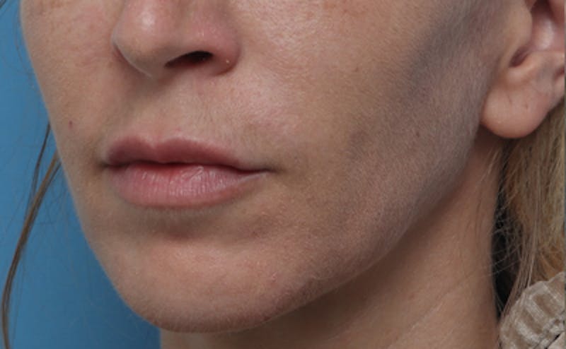 Lip Lift Before & After Gallery - Patient 167005 - Image 1