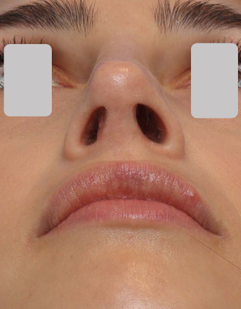 Favorite Revision Rhinoplasty Before & After Gallery - Patient 209131 - Image 8