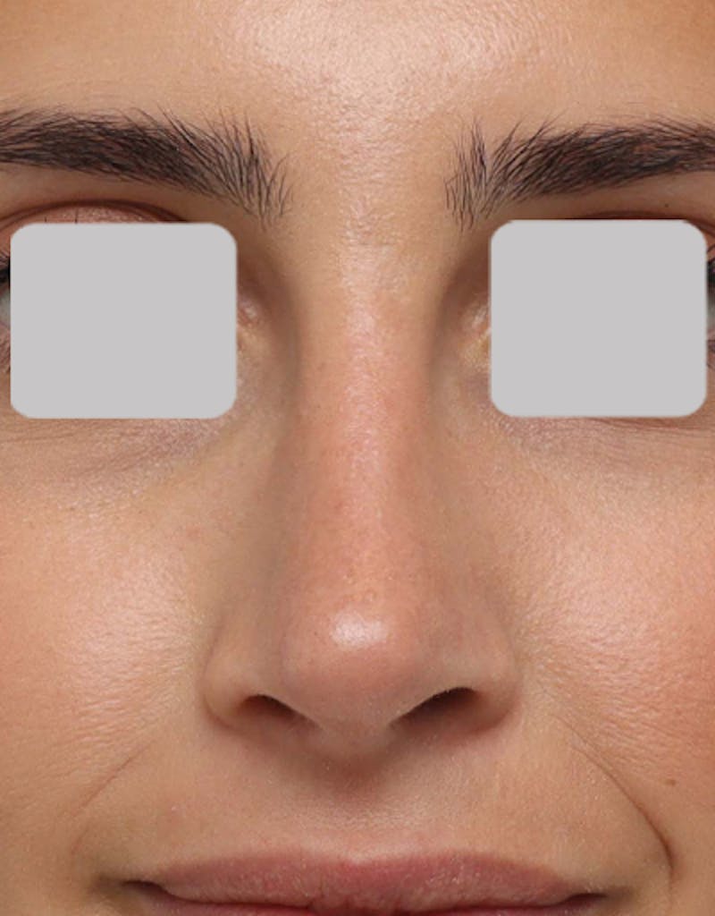 Favorite Revision Rhinoplasty Before & After Gallery - Patient 209131 - Image 2