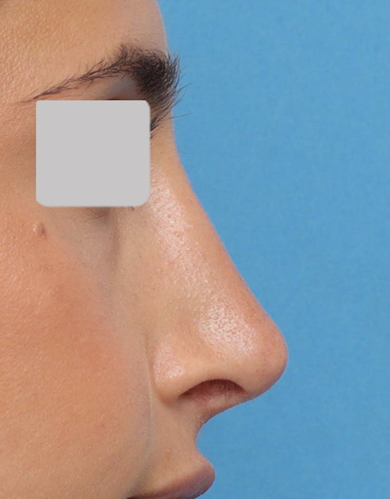 Favorite Revision Rhinoplasty Before & After Gallery - Patient 209131 - Image 4