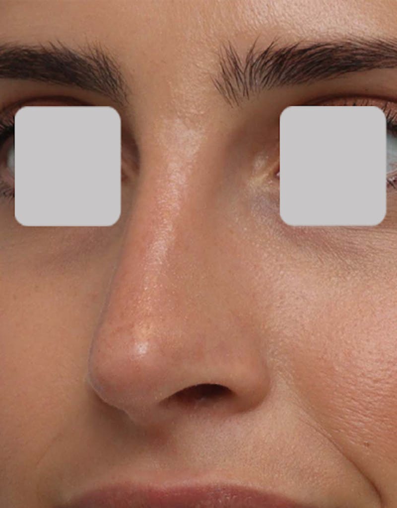 Favorite Revision Rhinoplasty Before & After Gallery - Patient 209131 - Image 6