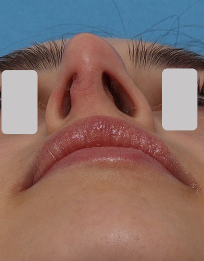 Favorite Revision Rhinoplasty Before & After Gallery - Patient 209131 - Image 7