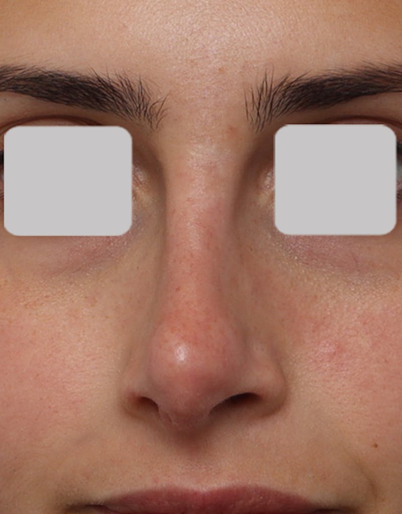 Favorite Revision Rhinoplasty Before & After Gallery - Patient 209131 - Image 1