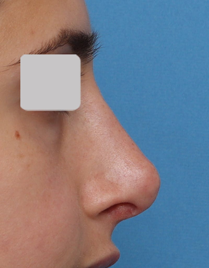 Favorite Revision Rhinoplasty Before & After Gallery - Patient 209131 - Image 3