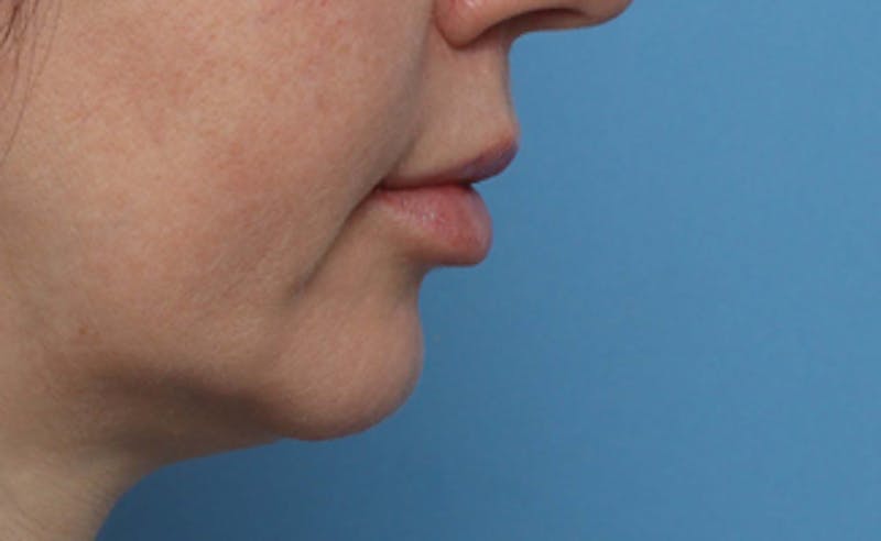 Lip Lift Before & After Gallery - Patient 270413 - Image 6