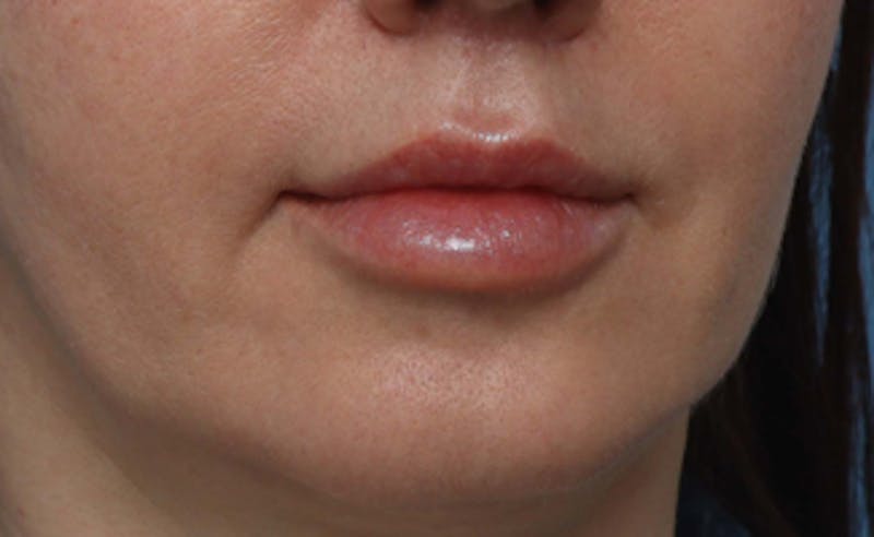 Lip Lift Before & After Gallery - Patient 270413 - Image 8