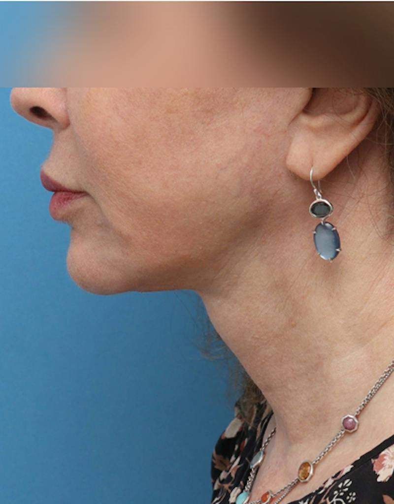 Facelift Before & After Gallery - Patient 197272 - Image 4