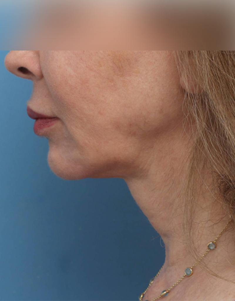 Facelift Before & After Gallery - Patient 197272 - Image 3