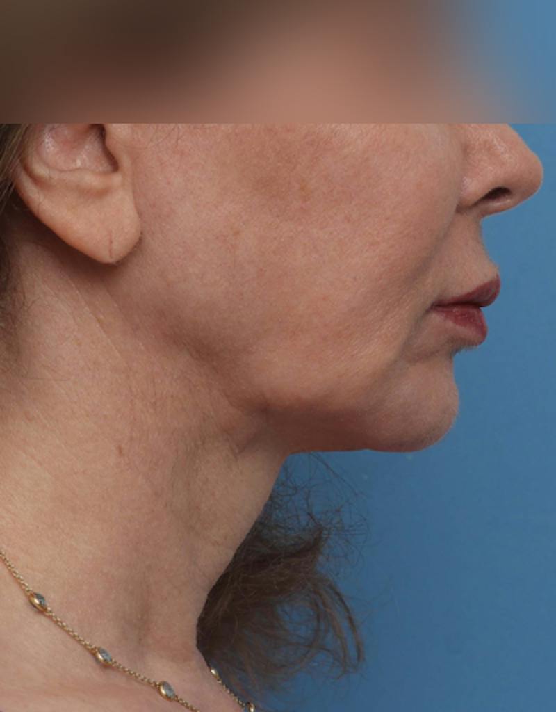 Patient NkYBCV18SHyHMA51-t-FSQ - Facelift Before & After Photos