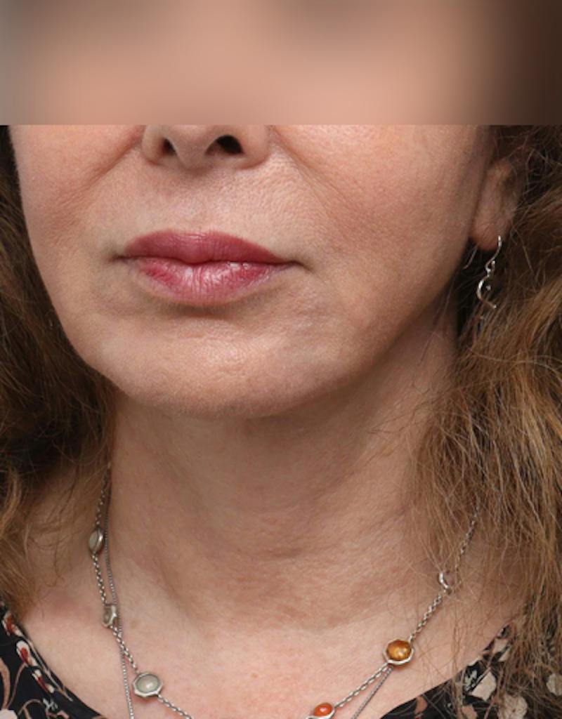 Facelift Before & After Gallery - Patient 197272 - Image 6