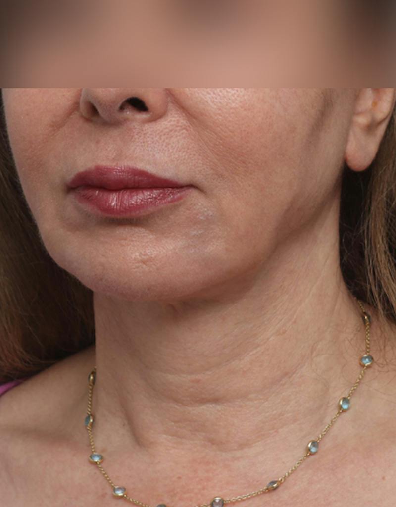 Facelift Before & After Gallery - Patient 197272 - Image 5