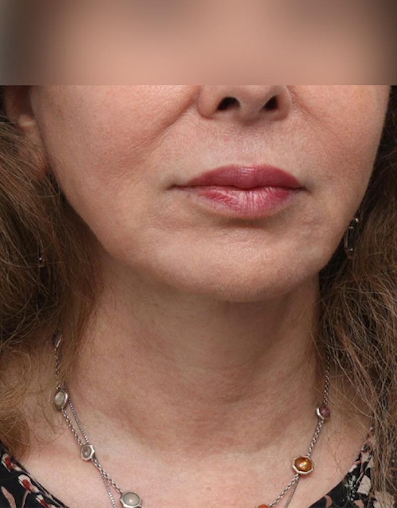 Facelift Before & After Gallery - Patient 197272 - Image 8