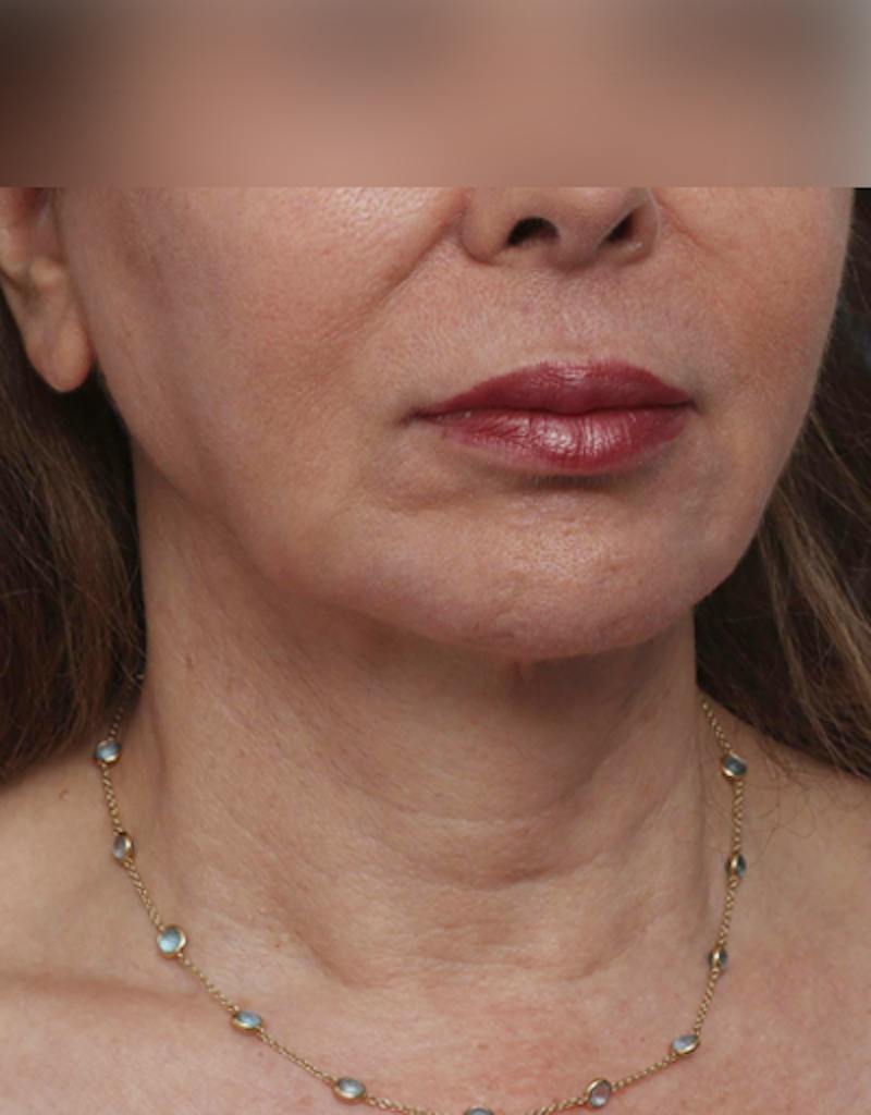 Facelift Before & After Gallery - Patient 197272 - Image 7