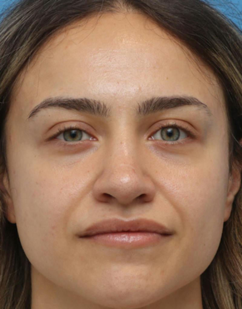 Rhinoplasty Before & After Gallery - Patient 259655 - Image 4