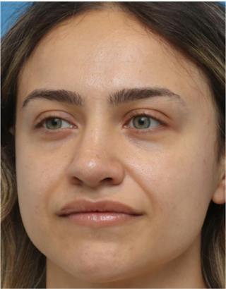 Rhinoplasty Before & After Gallery - Patient 259655 - Image 8