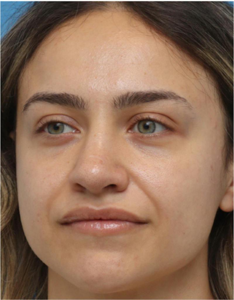 Rhinoplasty Before & After Gallery - Patient 259655 - Image 8