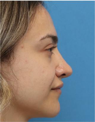 Rhinoplasty Before & After Gallery - Patient 259655 - Image 2