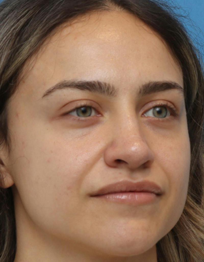 Rhinoplasty Before & After Gallery - Patient 259655 - Image 6