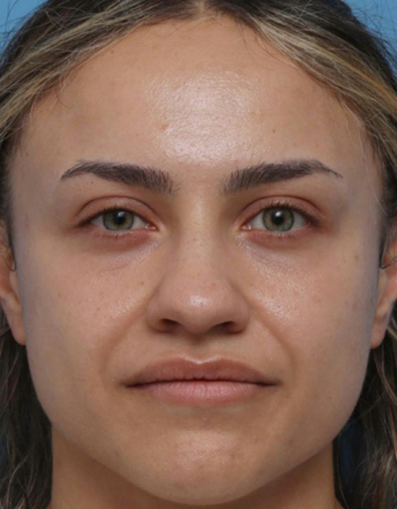 Rhinoplasty Before & After Gallery - Patient 259655 - Image 3