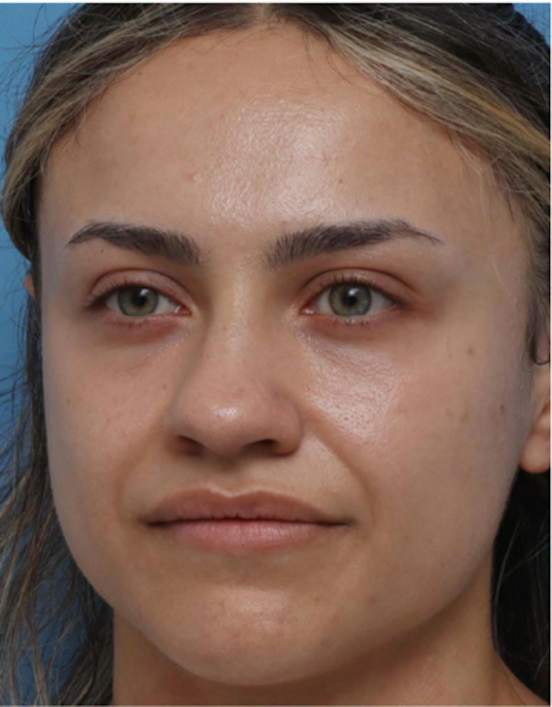 Rhinoplasty Before & After Gallery - Patient 259655 - Image 7