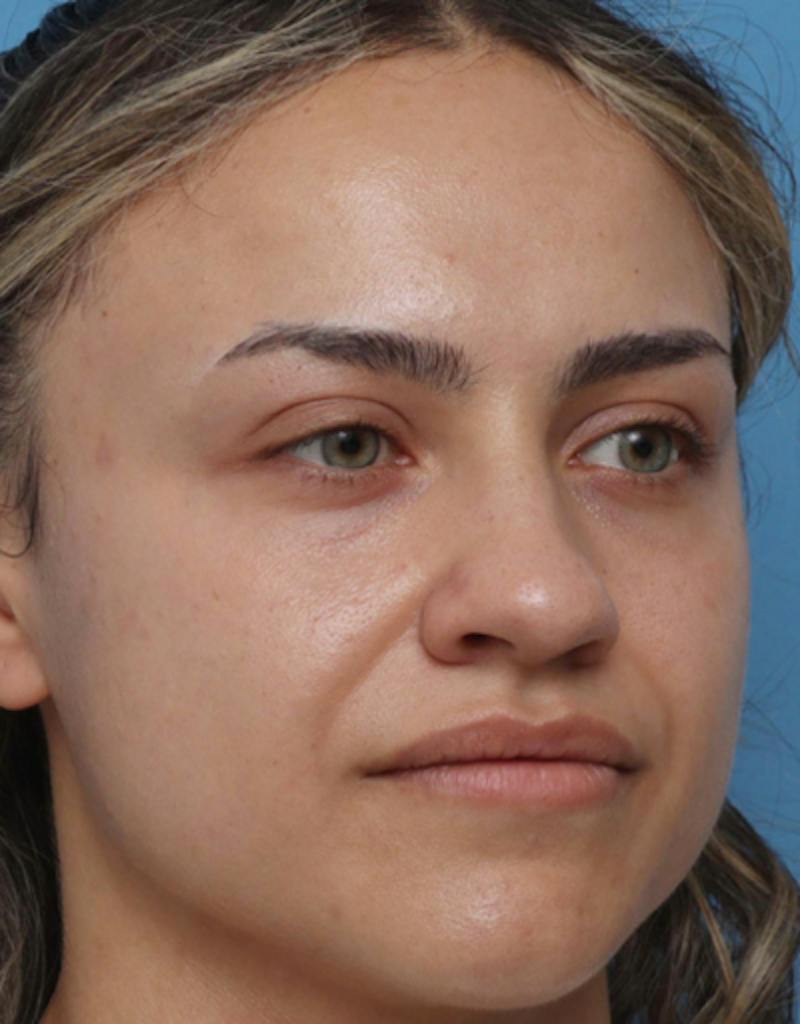 Rhinoplasty Before & After Gallery - Patient 259655 - Image 5