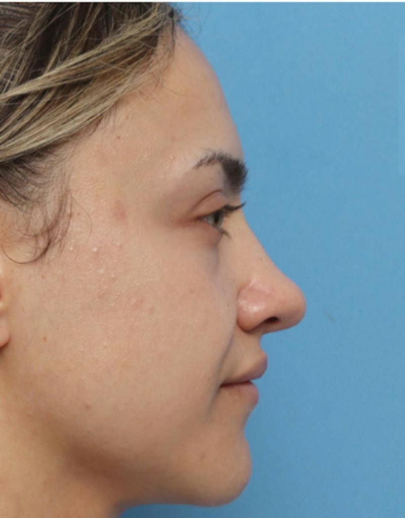 Patient cnZ83ayHS9e7GUvzhzZyRA - Rhinoplasty Before & After Photos