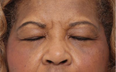 Eyelid Surgery Before & After Gallery - Patient 904655 - Image 1