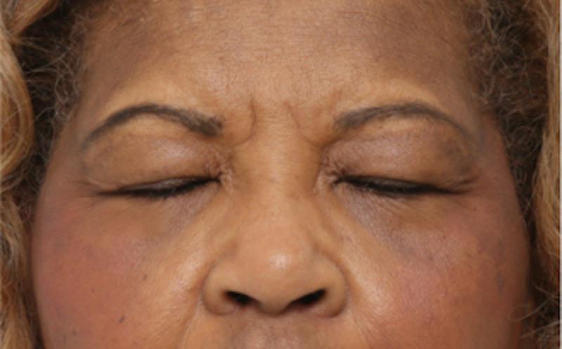 Eyelid Surgery Before & After Gallery - Patient 904655 - Image 1