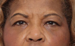 Eyelid Surgery Before & After Gallery - Patient 904655 - Image 2