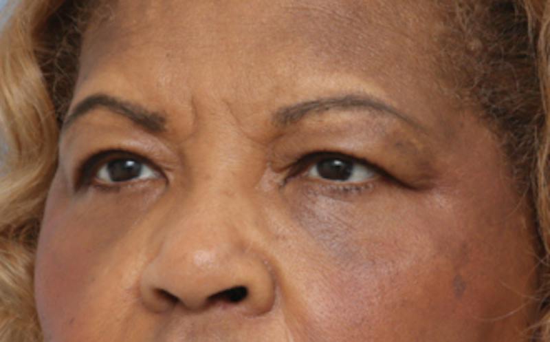 Eyelid Surgery Before & After Gallery - Patient 904655 - Image 6