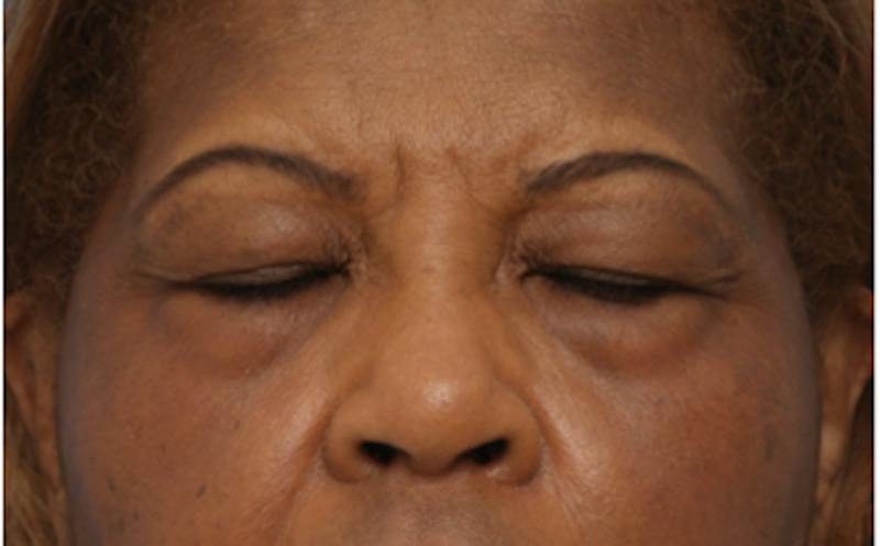 Eyelid Surgery Before & After Gallery - Patient 904655 - Image 5