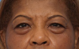 Eyelid Surgery Before & After Gallery - Patient 904655 - Image 4