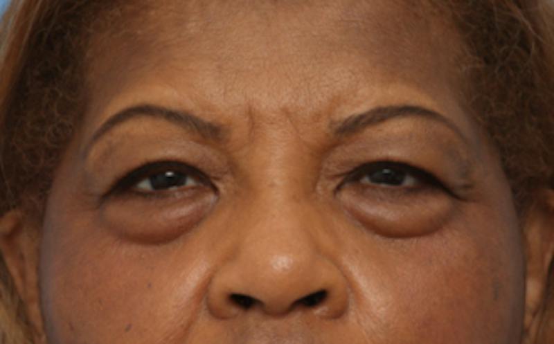 Eyelid Surgery Before & After Gallery - Patient 904655 - Image 4