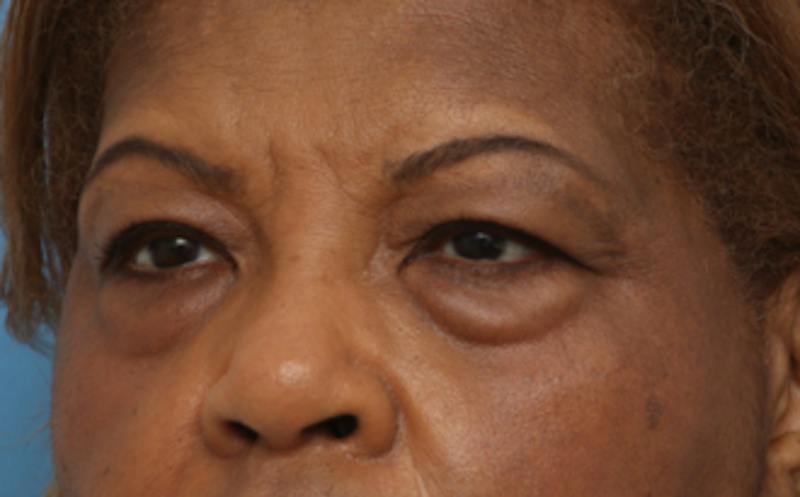 Eyelid Surgery Before & After Gallery - Patient 904655 - Image 3