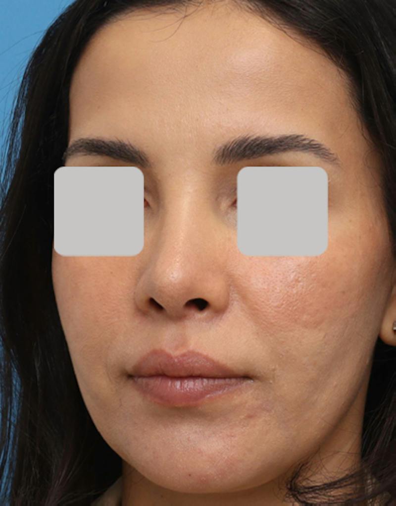 Rhinoplasty  Before & After Gallery - Patient 182736 - Image 8