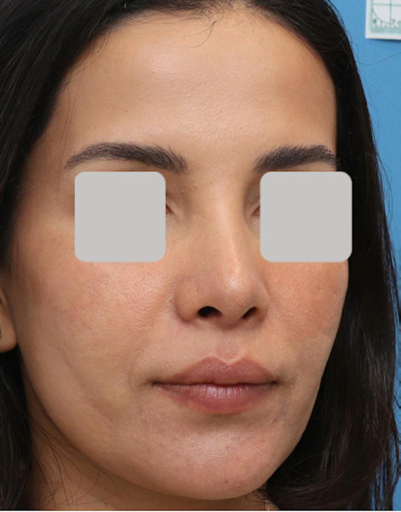 Rhinoplasty  Before & After Gallery - Patient 182736 - Image 6