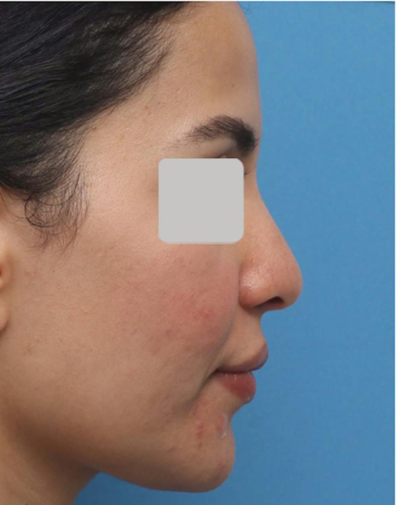 Rhinoplasty  Before & After Gallery - Patient 182736 - Image 3
