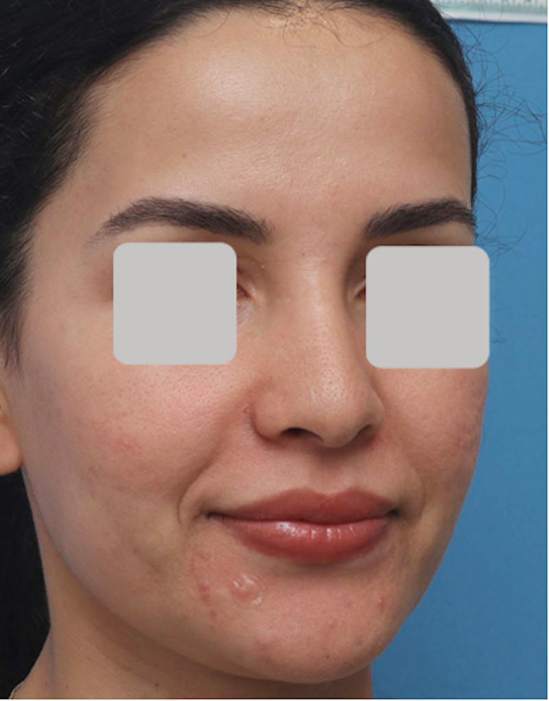 Rhinoplasty  Before & After Gallery - Patient 182736 - Image 5